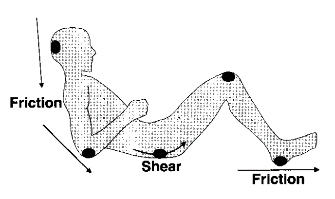 Picture pressure sore causes- reclining man with orssure ppoints, drawing Picture pressure sore causes- reclining man with orssure ppoints, drawing